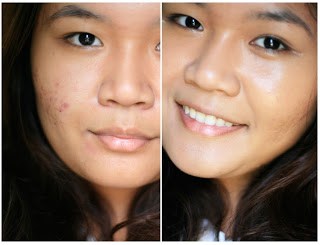 Tips Cara Menghilangkan Bekas Jerawat Dengan Cepat Tips Cara Menghilangkan Bekas Jerawat Dengan Cepat