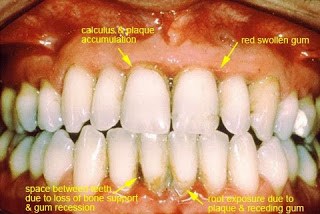 Cara Menghilangkan Karang Gigi dengan Alami