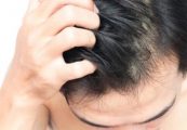 tips menghilangkan gatal kulit kepala