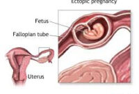 hamil di luar kandungan ciri ciri hamil diluar kandungan